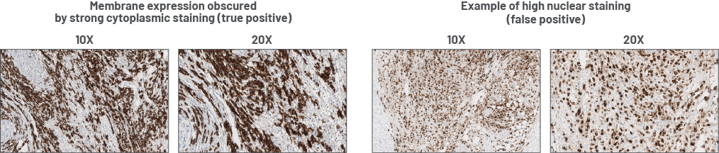 Cytoplasmic vs nuclear staining