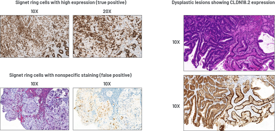 Signet ring cells and dysplastic lesions